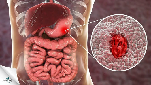 Язва: Същност, симптоми и лечение